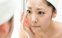 Chăm sóc da mụn đúng cách: Những điều người mới cần biết