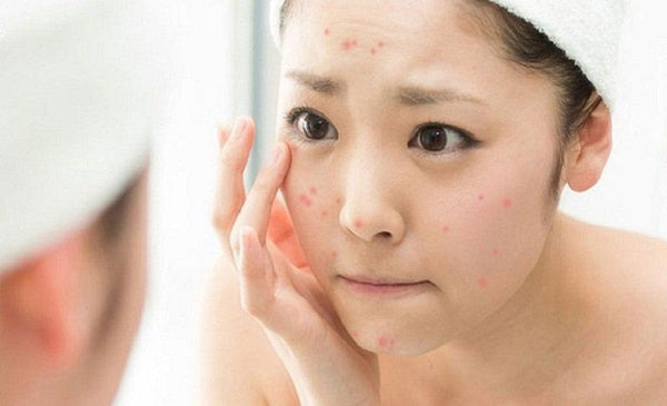 Chăm sóc da mụn đúng cách: Những điều người mới cần biết